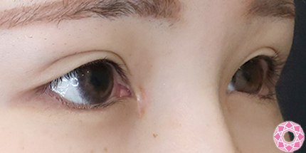 年代：20代 施術名：たれ目形成 施術後｜【公式】東京形成美容外科