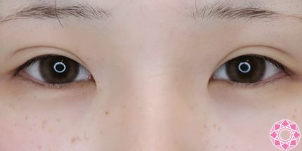 年代：20代 施術名：たれ目形成 施術前｜【公式】東京形成美容外科