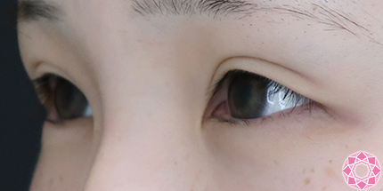 年代：20代 施術名：たれ目形成 施術前｜【公式】東京形成美容外科