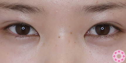 年代：10代 施術名：二重埋没法 施術後｜【公式】東京形成美容外科