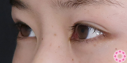 年代：10代 施術名：二重埋没法 施術後｜【公式】東京形成美容外科