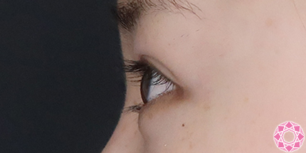 年代：10代 施術名：二重埋没法 施術後｜【公式】東京形成美容外科