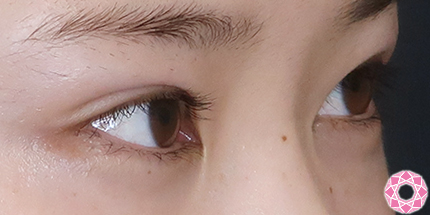 年代：10代 施術名：二重埋没法 施術後｜【公式】東京形成美容外科