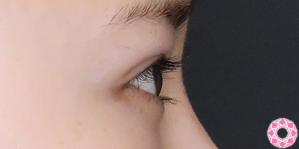 年代：10代 施術名：二重埋没法 施術後｜【公式】東京形成美容外科