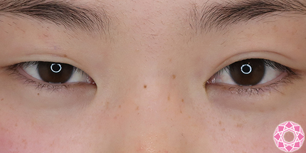 年代：10代 施術名：二重埋没法 施術前｜【公式】東京形成美容外科