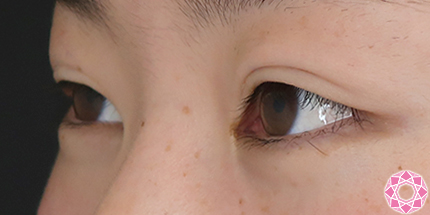 年代：10代 施術名：二重埋没法 施術前｜【公式】東京形成美容外科