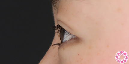 年代：10代 施術名：二重埋没法 施術前｜【公式】東京形成美容外科