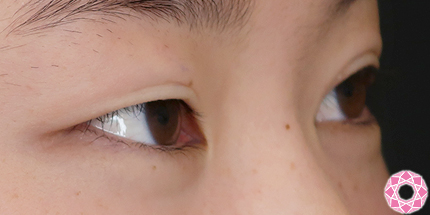 年代：10代 施術名：二重埋没法 施術前｜【公式】東京形成美容外科