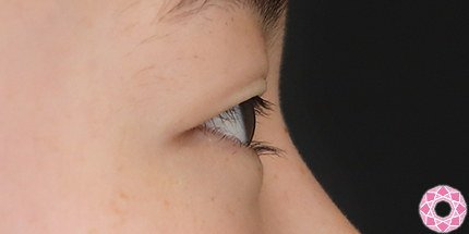 年代：10代 施術名：二重埋没法 施術前｜【公式】東京形成美容外科