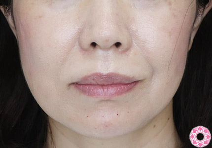 年代：50代 施術名：ジュビダーム 施術後｜【公式】東京形成美容外科