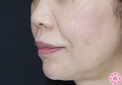 年代：50代 施術名：ジュビダーム 施術後｜【公式】東京形成美容外科