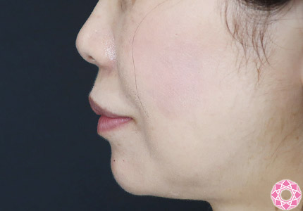 年代：50代 施術名：ジュビダーム 施術後｜【公式】東京形成美容外科