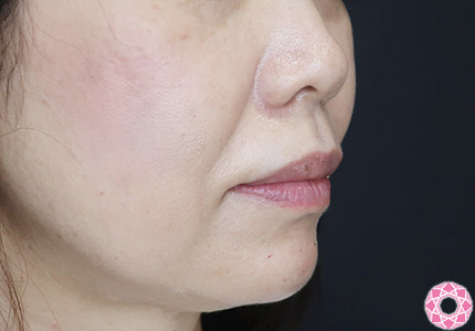 年代：50代 施術名：ジュビダーム 施術後｜【公式】東京形成美容外科
