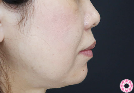 年代：50代 施術名：ジュビダーム 施術後｜【公式】東京形成美容外科