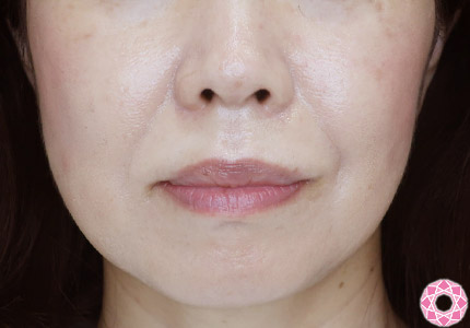 年代：50代 施術名：ジュビダーム 施術前｜【公式】東京形成美容外科