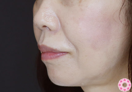 年代：50代 施術名：ジュビダーム 施術前｜【公式】東京形成美容外科