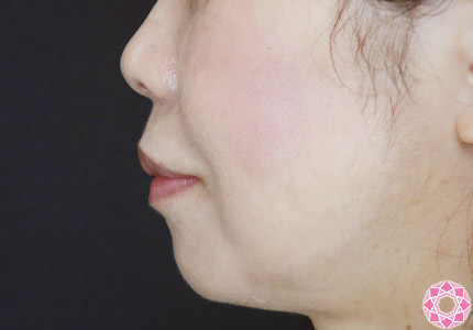 年代：50代 施術名：ジュビダーム 施術前｜【公式】東京形成美容外科