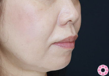 年代：50代 施術名：ジュビダーム 施術前｜【公式】東京形成美容外科