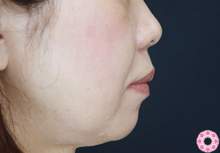 年代：50代 施術名：ジュビダーム 施術前｜【公式】東京形成美容外科