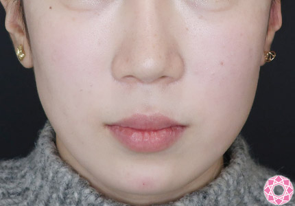 年代：10代 施術名：ジュビダーム 施術後｜【公式】東京形成美容外科