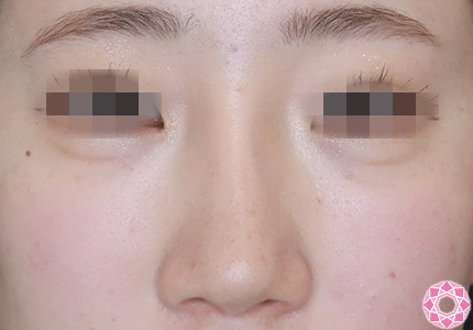 年代：10代 施術名：隆鼻術（シリコンプロテーゼ） 施術後｜【公式】東京形成美容外科