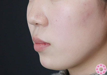 年代：10代 施術名：ジュビダーム 施術後｜【公式】東京形成美容外科