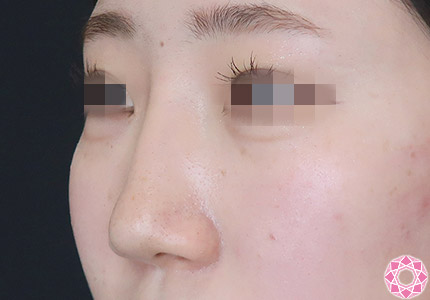 年代：10代 施術名：隆鼻術（シリコンプロテーゼ） 施術後｜【公式】東京形成美容外科