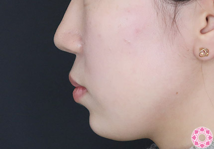 年代：10代 施術名：ジュビダーム 施術後｜【公式】東京形成美容外科