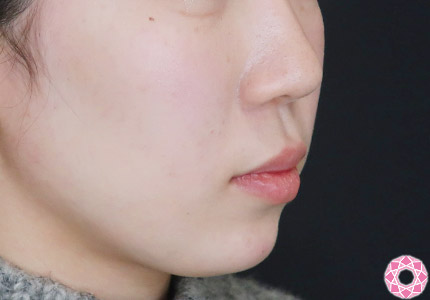 年代：10代 施術名：ジュビダーム 施術後｜【公式】東京形成美容外科