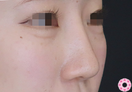 年代：10代 施術名：隆鼻術（シリコンプロテーゼ） 施術後｜【公式】東京形成美容外科