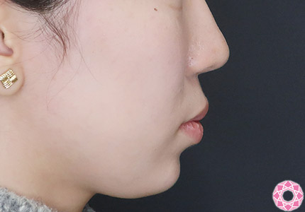 年代：10代 施術名：ジュビダーム 施術後｜【公式】東京形成美容外科