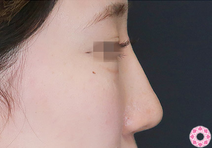 年代：10代 施術名：隆鼻術（シリコンプロテーゼ） 施術後｜【公式】東京形成美容外科