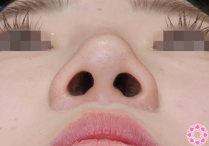 年代：10代 施術名：隆鼻術（シリコンプロテーゼ） 施術後｜【公式】東京形成美容外科