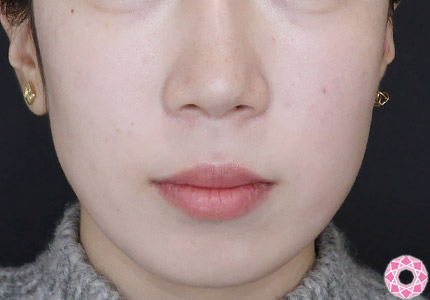 年代：10代 施術名：ジュビダーム 施術前｜【公式】東京形成美容外科