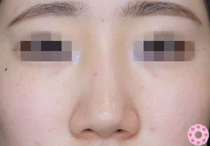 年代：10代 施術名：隆鼻術（シリコンプロテーゼ） 施術前｜【公式】東京形成美容外科