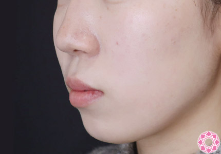 年代：10代 施術名：ジュビダーム 施術前｜【公式】東京形成美容外科