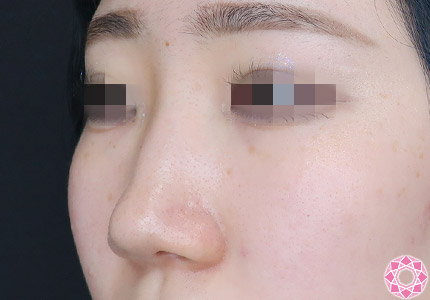 年代：10代 施術名：隆鼻術（シリコンプロテーゼ） 施術前｜【公式】東京形成美容外科