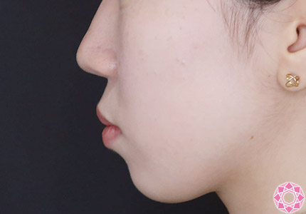 年代：10代 施術名：ジュビダーム 施術前｜【公式】東京形成美容外科