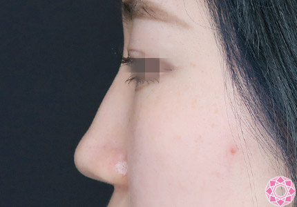 年代：10代 施術名：隆鼻術（シリコンプロテーゼ） 施術前｜【公式】東京形成美容外科