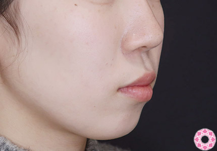 年代：10代 施術名：ジュビダーム 施術前｜【公式】東京形成美容外科