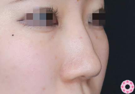 年代：10代 施術名：隆鼻術（シリコンプロテーゼ） 施術前｜【公式】東京形成美容外科