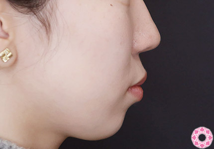年代：10代 施術名：ジュビダーム 施術前｜【公式】東京形成美容外科