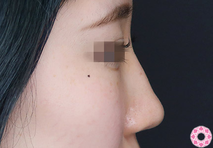 年代：10代 施術名：隆鼻術（シリコンプロテーゼ） 施術前｜【公式】東京形成美容外科