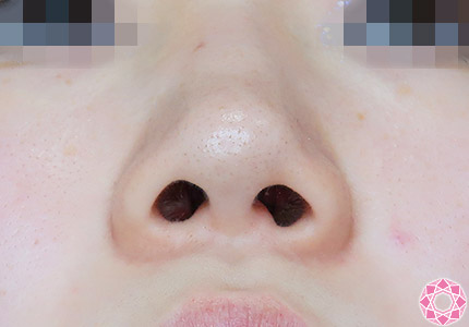 年代：10代 施術名：隆鼻術（シリコンプロテーゼ） 施術前｜【公式】東京形成美容外科