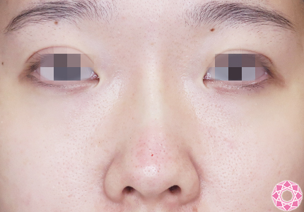 年代：20代 施術名：プチ隆鼻術（ヒアルロン酸） 施術後｜【公式】東京形成美容外科