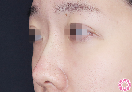 年代：20代 施術名：プチ隆鼻術（ヒアルロン酸） 施術後｜【公式】東京形成美容外科