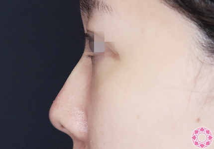 年代：20代 施術名：プチ隆鼻術（ヒアルロン酸） 施術後｜【公式】東京形成美容外科