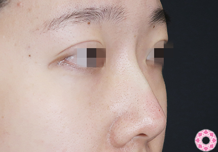 年代：20代 施術名：プチ隆鼻術（ヒアルロン酸） 施術後｜【公式】東京形成美容外科