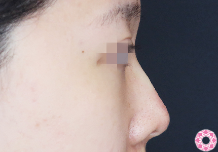 年代：20代 施術名：プチ隆鼻術（ヒアルロン酸） 施術後｜【公式】東京形成美容外科