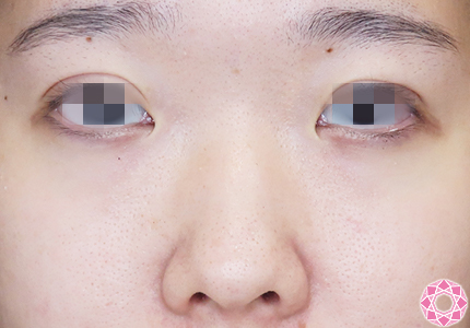 年代：20代 施術名：プチ隆鼻術（ヒアルロン酸） 施術前｜【公式】東京形成美容外科